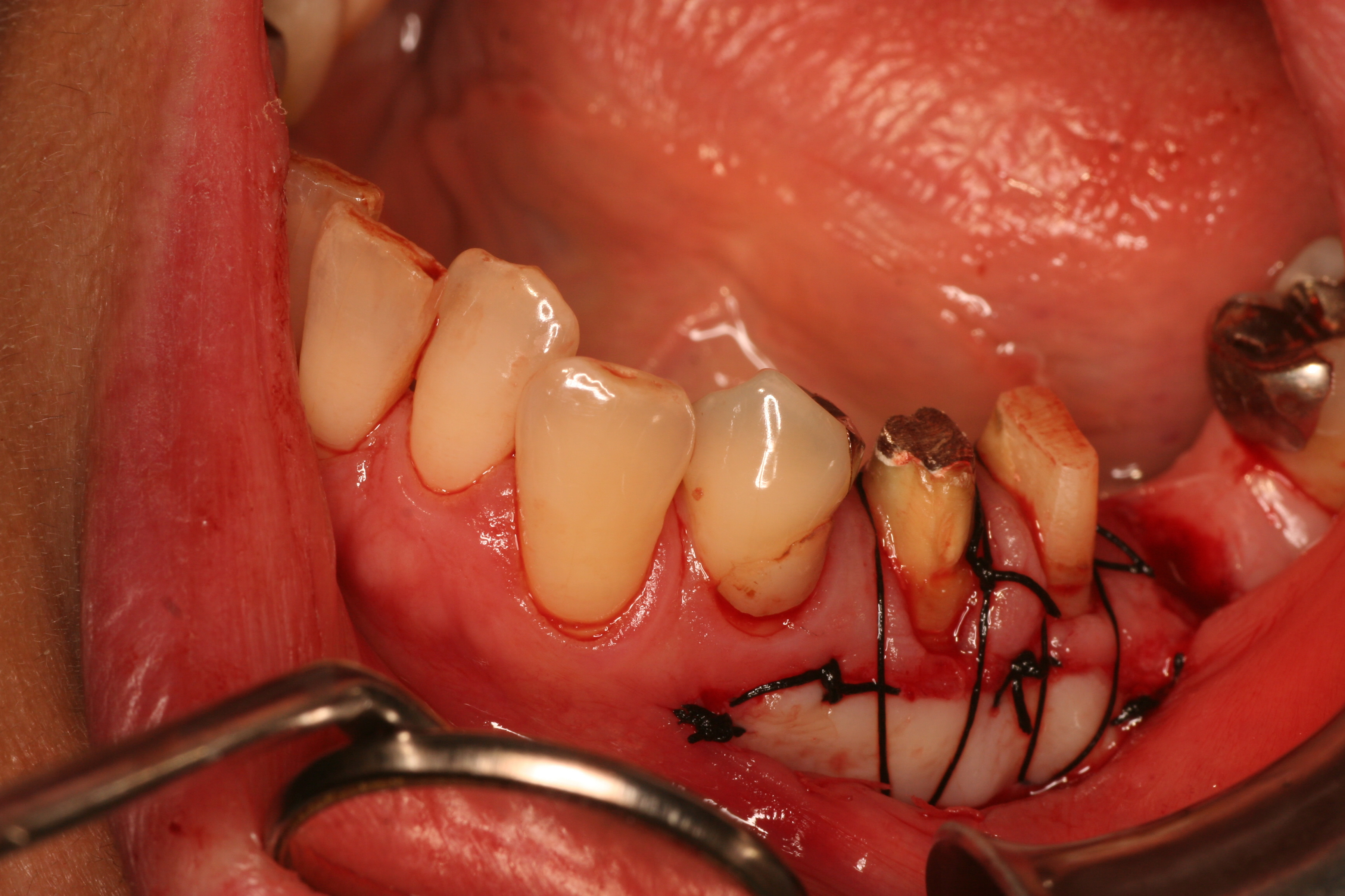 歯肉移植手術（自費治療、一部保険適応）
