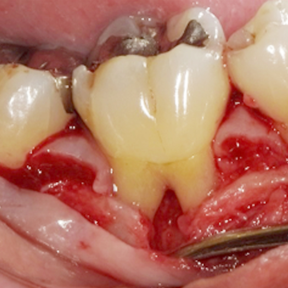 <p>術中:根分岐部の歯槽骨が吸収しています。この部分に新たな歯槽骨を再生させることが目標です。</p>
